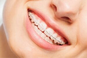 Smile with clean braces