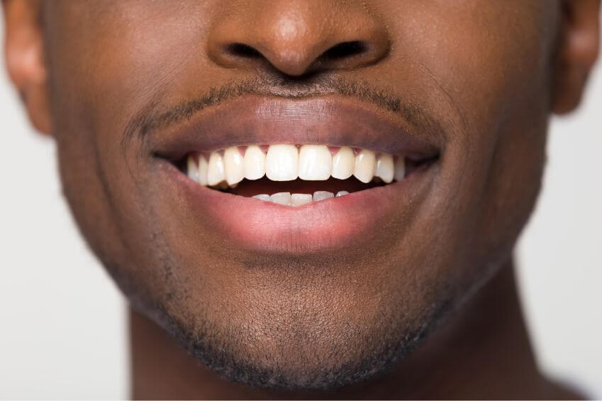 Man smiling with straight teeth after invisalign treatment at Beeston Dental Practice