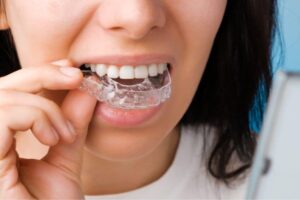Woman putting Invisalign Aligners on teeth