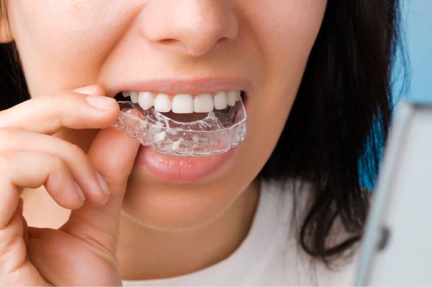 Woman putting Invisalign Aligners on teeth
